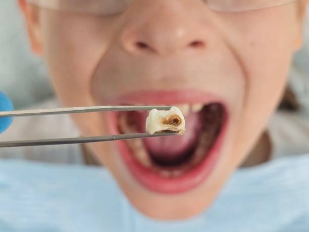Best Urgent Care for Lost Fillings or Crowns in East Greenville, PA